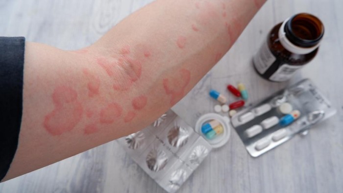 Reaksi Alergi Syok Anafilaktik Bisa Ancam Jiwa, Ini Cara Mencegahnya