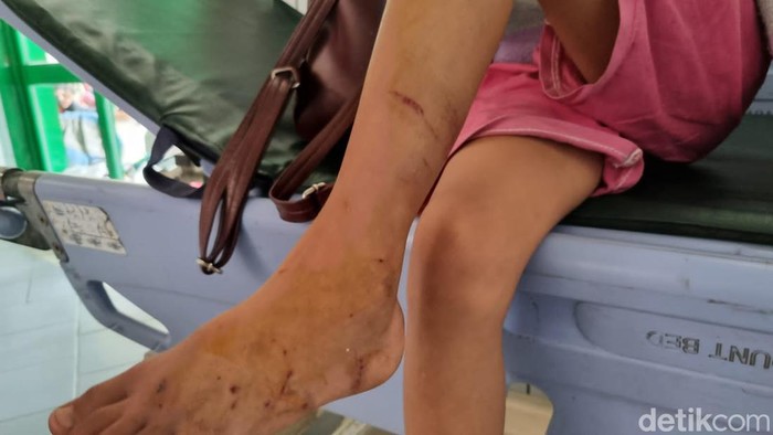 dua anak dicakar monyet di kawasan jagir wonokromo