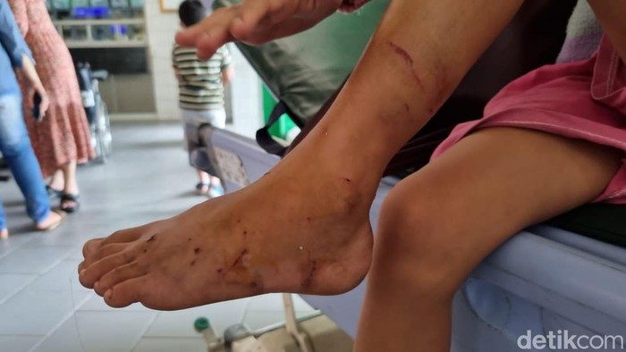 dua anak dicakar monyet di kawasan jagir wonokromo