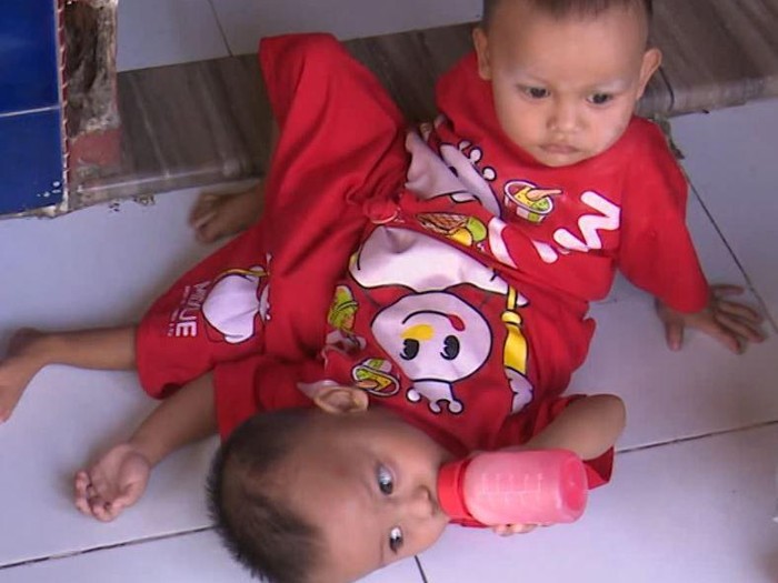 Pilunya kisah Adam dan Malika, bayi kembar siam yang lahir dengan kondisi tubuh menyatu di bagian perut. Yuk, kita bantu Adam dan Malika lewat berbuatbaik.id.