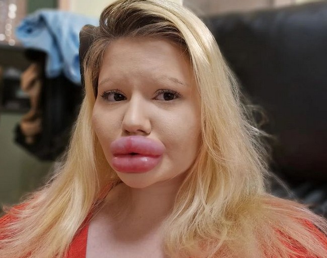 Wanita 25 tahun itu telah melakukan 43 kali prosedur pembesaran bibir, termasuk filler. Semakin besar semakin membuatnya percaya diri. Foto: dok. Instagram/@andrea88476