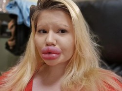 Wanita dengan Bibir Terbesar Tambah Filler untuk Natal, Bikin Takut Keluarga