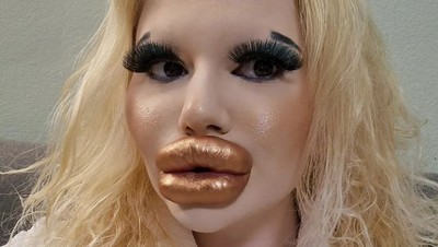 Foto: Penampakan Wanita Setelah 43 Kali Filler Bibir, Ngaku Sulit Dapat Pacar