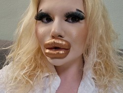 Foto: Penampakan Wanita Setelah 43 Kali Filler Bibir, Ngaku Sulit Dapat Pacar