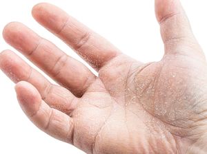 Xerosis