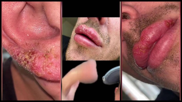 Viral Kisah Pria Keracunan Sinar Matahari, Bibir-Telinganya Hancur Melepuh
