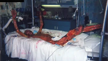 Hisashi Ouchi adalah korban radiasi nuklir yang fatal dari kebocoran PLTN Tokaimura, 30 September 1999. Meskipun ingin mati, dia dibiarkan hidup dalam kesakitan yang luar biasa selama 83 hari di luar keinginannya karena menjadi objek penelitian ilmuwan. Foto: Ranker