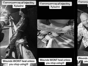 Ngerinya Efek Narkoba Zombie, Kulit Wanita Ini Sampai Membusuk