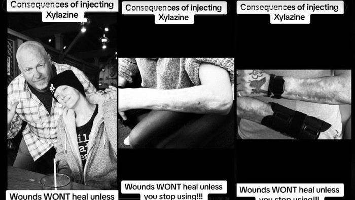 Cerita Wanita Kecanduan Narkoba Zombie, Kulitnya Sampai Membusuk