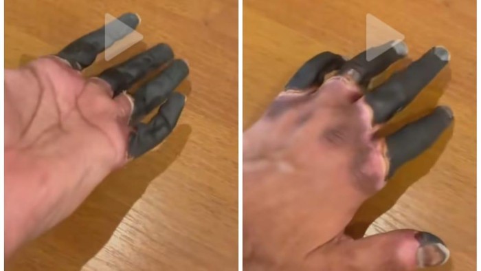 Viral Video Jari Menghitam Kena Frostbite Berujung Diamputasi