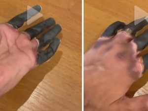 Mengenal Frostbite, Viral di TikTok Jari Menghitam-Membeku Bak Lilin