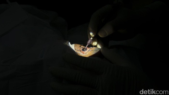 Upaya Mengurangi Katarak di RI