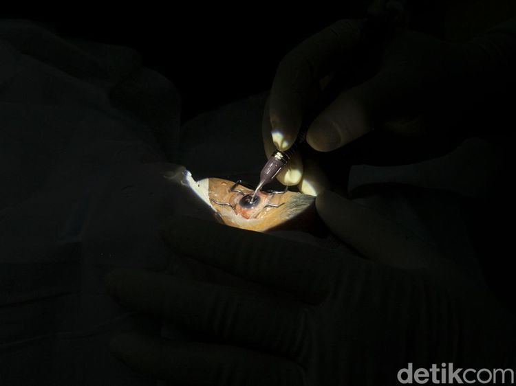 Upaya Mengurangi Katarak di RI