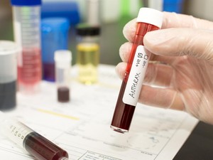 Eks Petinggi WHO Soroti 3 Warga DIY Meninggal Kena Antraks