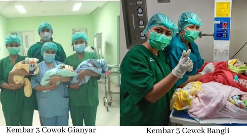 Bayi kembar tiga lahir di Gianyar dan Bangli dengan proses operasi cesar beberapa waktu lalu. Foto: istimewa