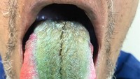 Seorang pria di Ohio, Amerika Serikat mengalami kondisi langka yang membuat lidahnya berbulu dan berwarna hijau. Menurut studi yang dipublikasikan di New England Journal of Medicine, tiga minggu sebelum kejadian tersebut, pasien baru saja menyelesaikan pengobatan antibiotik klindamisin untuk infeksi gusi. (Foto: New England Journal of Medicine)