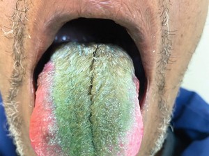 Fakta-fakta Pria Lidah Berbulu, Punya Kebiasaan Merokok-Konsumsi Antibiotik