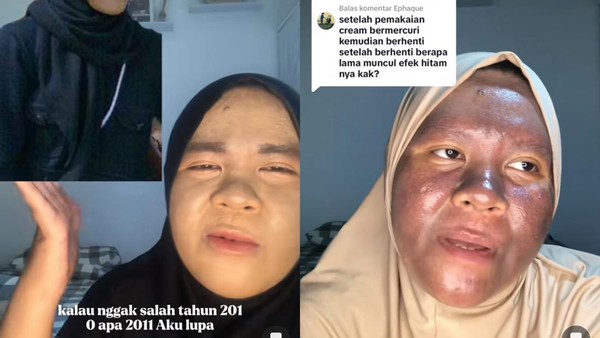 Viral Wajah Wanita Kaltim 'Menggosong', Bertahun-tahun Pakai Krim Merkuri