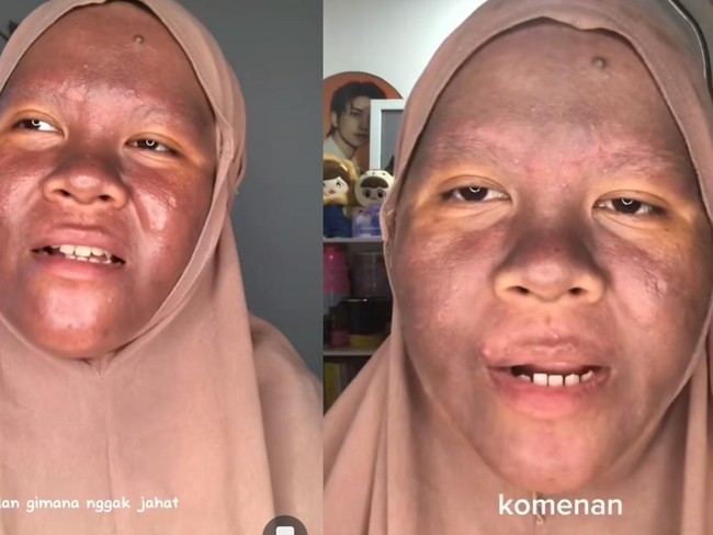 Viral curhat wanita wajahnya menggosong gegara krim pemutih merkuri