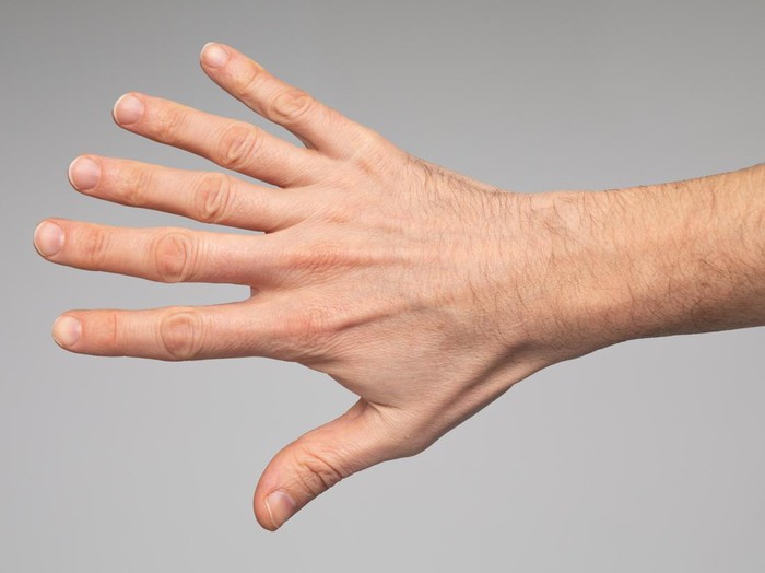 Case of polidactyly. Close up of hand of man with hexadactyly. Six  fingers in the same hand.