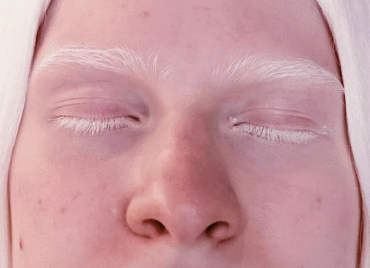 Dag-dig-dug Penderita Albinisme di Tengah Panas Ekstrem Roma