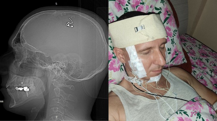 Peneliti Rusia Nekat Pasang Chip di Otaknya Modal Nonton Video di Youtube