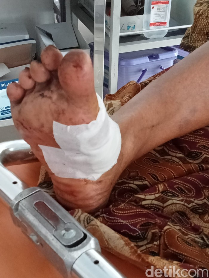warga jember digigit monyet liar mengalami luka-luka