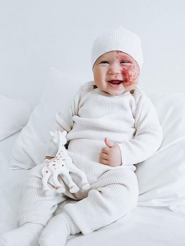 Brooke Atkins dan Kingsley Brooke Atkins, ibu yang di-bully karena laser wajah anaknya.