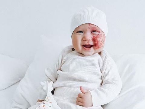 Brooke Atkins, ibu yang di-bully karena laser wajah anaknya.