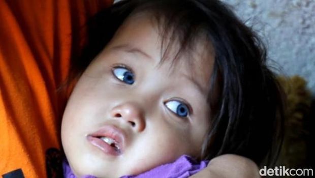 Amelia Anggraeni saat masih berumur 2,5 tahun