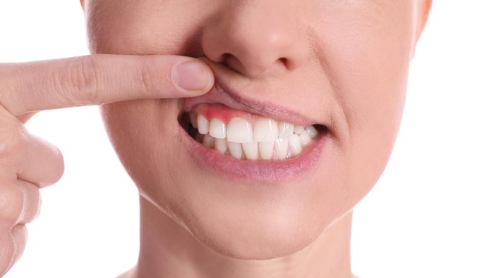 Woman showing inflamed gums on white background, closeup view
