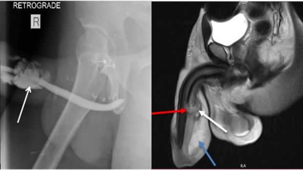 Hasil MRI fraktur penis atau patah penis pria di Tanzania