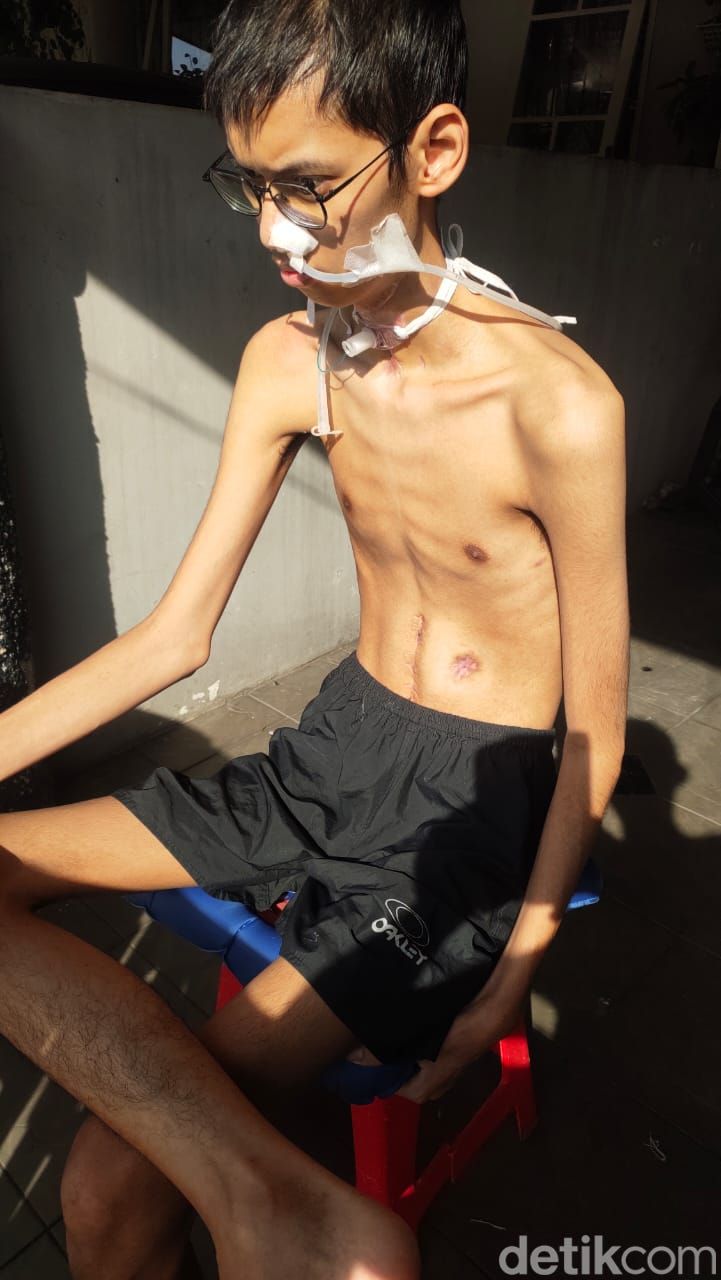Sultan Rif'at Alfatih (20) kini tak bisa hidup normal. Mahsiswa Universitas Brawijaya ini kini tak bisa bersuara usai lehernya terkena kabel yang menjuntai.