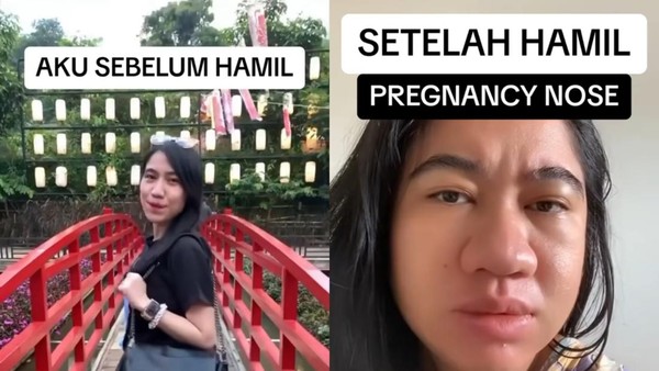 Viral Wanita Sumut Alami Pregnancy Nose, Hidung Jadi Membesar saat Hamil