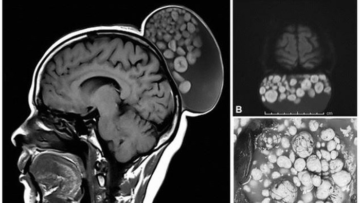 Penampakan Kepala Wanita yang Ditumbuhi Kista, Berisi Rambut dan Gumpalan Lemak