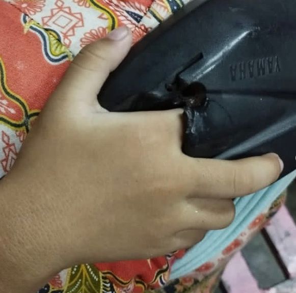 Tangan bocah kejepit spion motor.