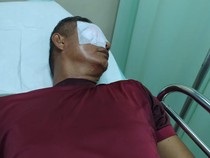 Kondisi Mata Guru di Bengkulu yang Dikatapel Ortu Murid Kesal Anaknya Dihukum