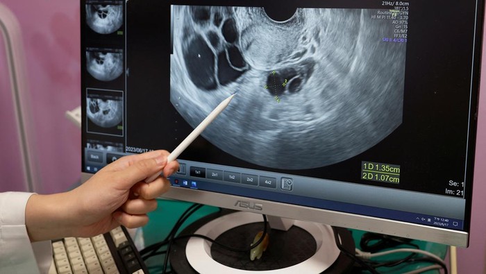 Heboh Wanita Lajang di Taiwan Beramai-ramai Ingin Egg Freezing, Begini Curhatnya