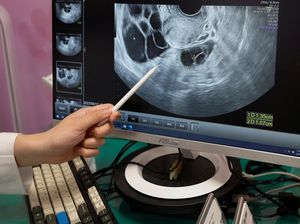 Heboh Wanita Lajang di Taiwan Beramai-ramai Ingin Egg Freezing, Begini Curhatnya