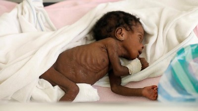 Kasihan, Krisis Pangan di Haiti Bikin Anak-anak Malnutrisi