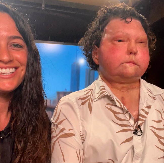 Joe mengalami kecelakaan mobil pada tahun 2018 yang menyebabkan luka bakar parah di 80% tubuhnya. Dua tahun setelahnya dia mendapatkan transplantasi ganda. Foto: dok. Instagram/@jessicakoby