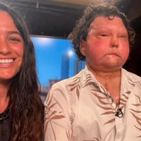 Joe mengalami kecelakaan mobil pada tahun 2018 yang menyebabkan luka bakar parah di 80% tubuhnya. Dua tahun setelahnya dia mendapatkan transplantasi ganda. Foto: dok. Instagram/@jessicakoby