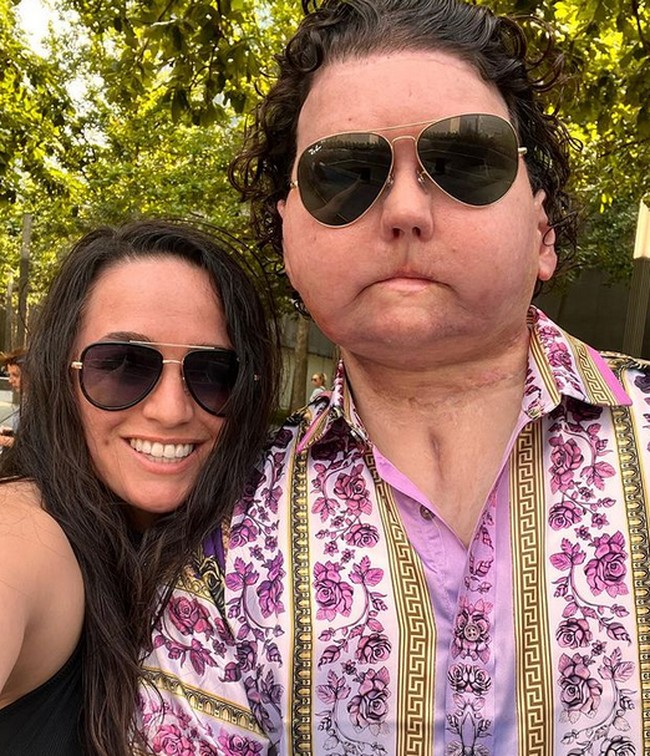 Pria 24 tahun itu mendapatkan transplantasi wajah ganda dari seorang donor yang berusia 48 tahun. Sebanyak 20 kali operasi plastik telah dilalui Joe. Foto: dok. Instagram/@jessicakoby