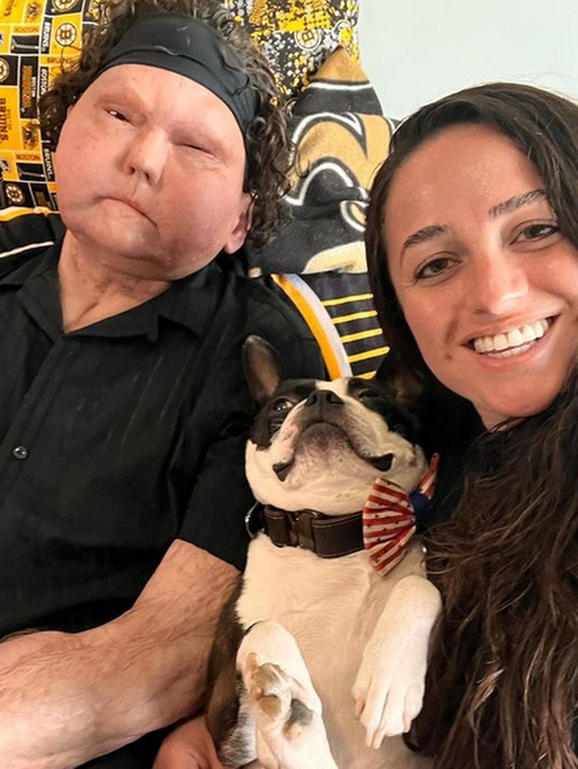 8 Foto Kehidupan Cinta Pria dengan Wajah Transplantasi, Romantis dengan Pacar