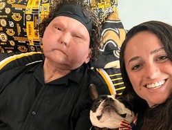 8 Foto Kehidupan Cinta Pria dengan Wajah Transplantasi, Romantis dengan Pacar