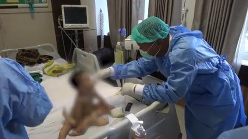 Tim dokter saat memeriksa kondisi bayi kaki enam di ruang operasi RSUP NTB, Jumat (4/7/2023). (Humas RSUP NTB)