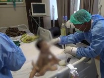 Tim Dokter Pastikan Jenis Kelamin Bayi Berkaki Enam Laki-laki