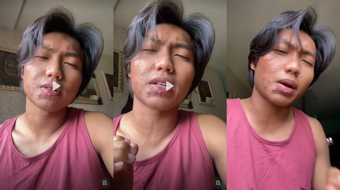 Viral Pria Ngeluh Bintik-bintik Nyaris di Seluruh Wajah, Dituding Kena Sifilis