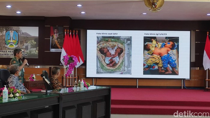 Bayi kembar siam asal Pasuruan akan jalani operasi pemisahan di RSSA Sabtu besok