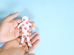 IDAI Sebut Kasus Cacar Air Anak Meningkat, Ini Kemungkinan Penyebabnya
